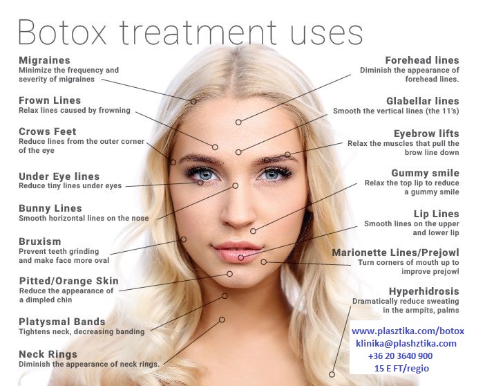Botox ránctalanítás, botox kezelés, botox